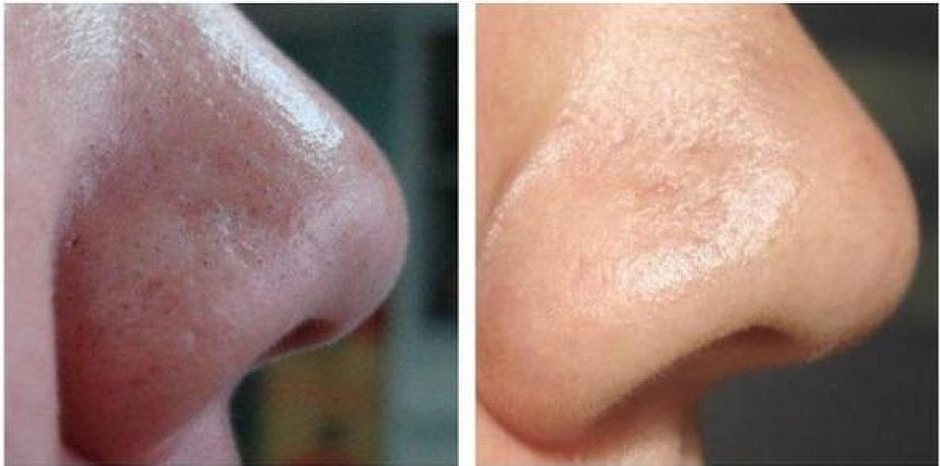 Aparat electric cu  vacuum pentru extractia comedoanelor si a punctelor negre