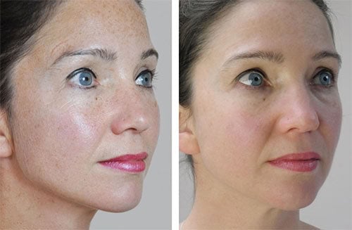 Dermaroller dispozitiv  pentru regenerarea pielii 0,5 mm