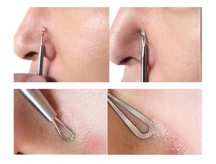 Trusa 5 instrumente inox pentru extractia comedoanelor si a punctelor negre